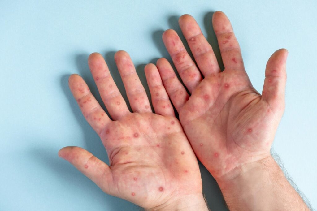 Joinville confirma mais dois casos de Monkeypox
