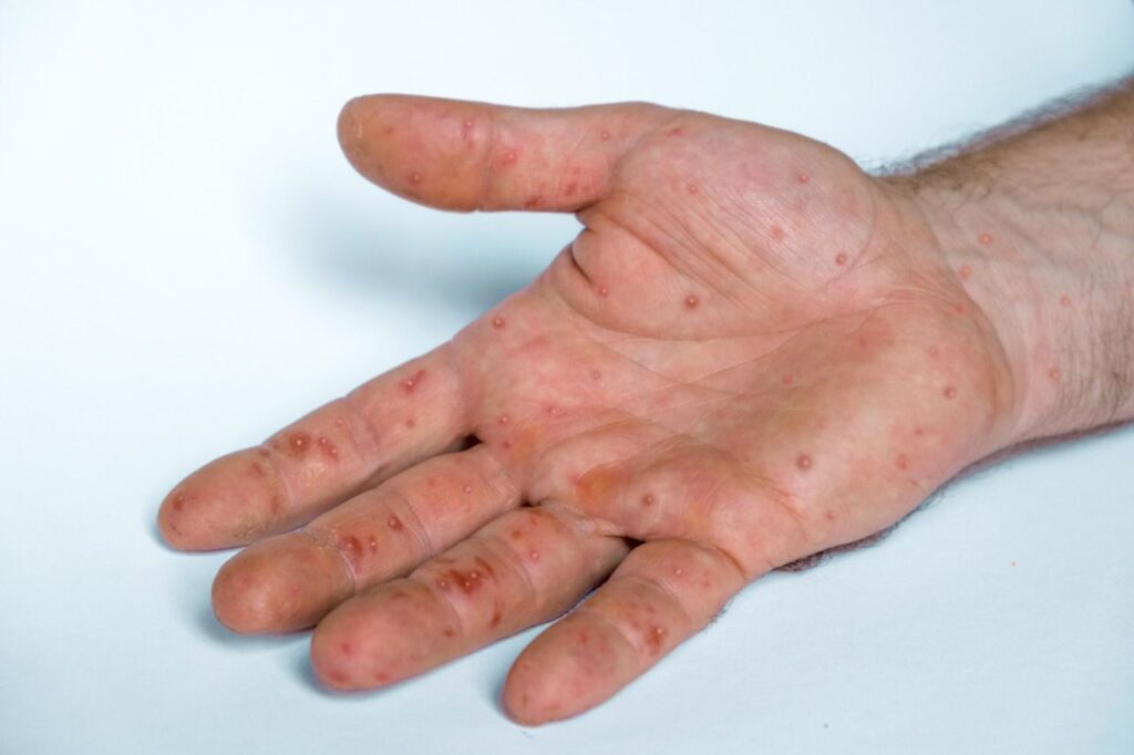 Joinville confirma terceiro caso de Monkeypox