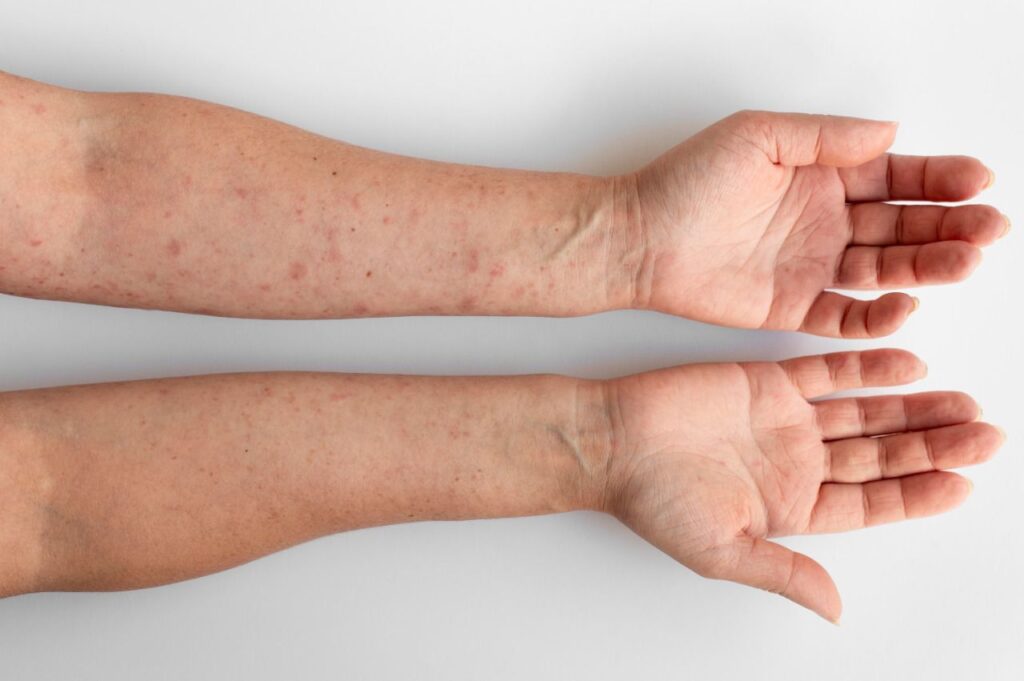 Joinville confirma mais três casos de Monkeypox