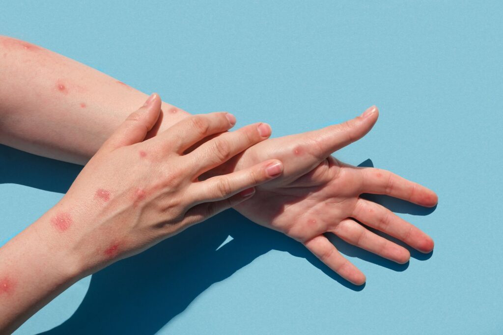 Joinville confirma mais três casos de Monkeypox